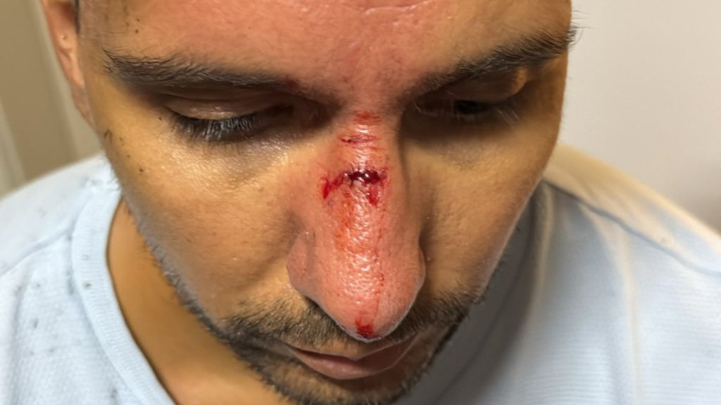 JEZIVO NASILJE BLOKADERA: Pogodili mladića kamenicom u glavu! (FOTO)