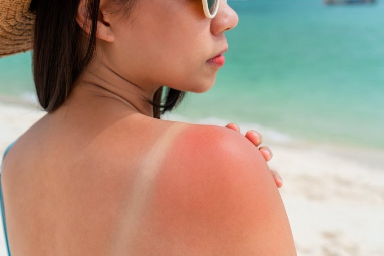 MNOGI SRBI NE ZNAJU DA NA PLAŽI VREBA I SOLARNA URTIKARIJA! Evo koji su simptomi i kako da se zaštitite PRE NEGO ŠTO BUDE KASNO