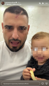 DARKO LAZIĆ POKAZAO POSLEDICE TEŠKOG UDESA! Pevač sve obelodanio sve na instagramu! (FOTO)