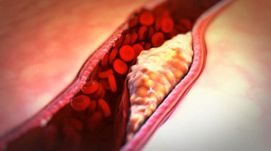 SVAKI DRUGI SRBIN BOLUJE OD OVE BOLESTI: Kardiolog otkriva kako vežbanje čuva krvne sudove I produžava život