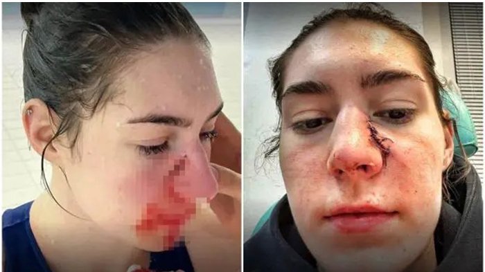 REPREZENTATIVKA SRBIJE DOŽIVELA JEZIVU POVREDU - LICE JOJ JE UNAKAŽENO!