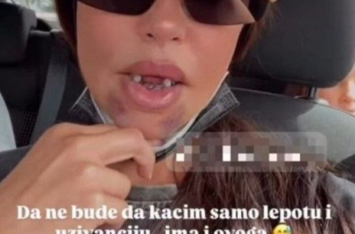 UZNEMIRUJUĆE! Dijana Dilajn imala stravičnu nezgodu, POKAZALA LICE U MODRICAMA I BEZ ZUBA! (GALERIJA)