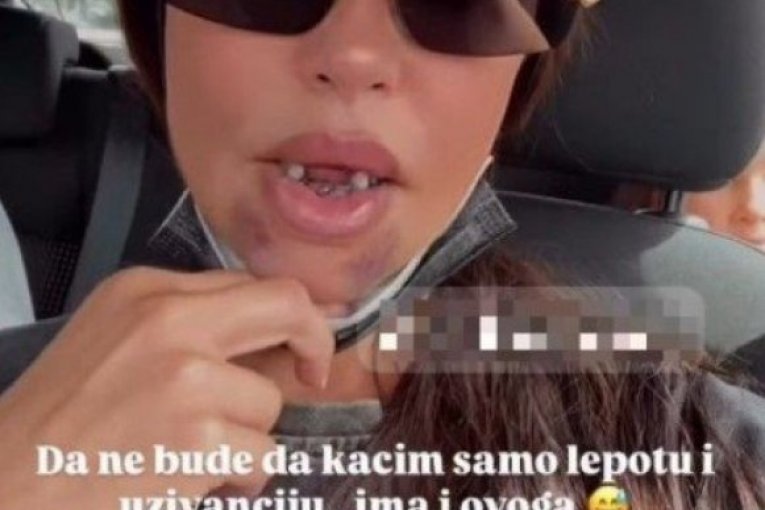 UZNEMIRUJUĆE! Dijana Dilajn imala stravičnu nezgodu, POKAZALA LICE U MODRICAMA I BEZ ZUBA! (GALERIJA)